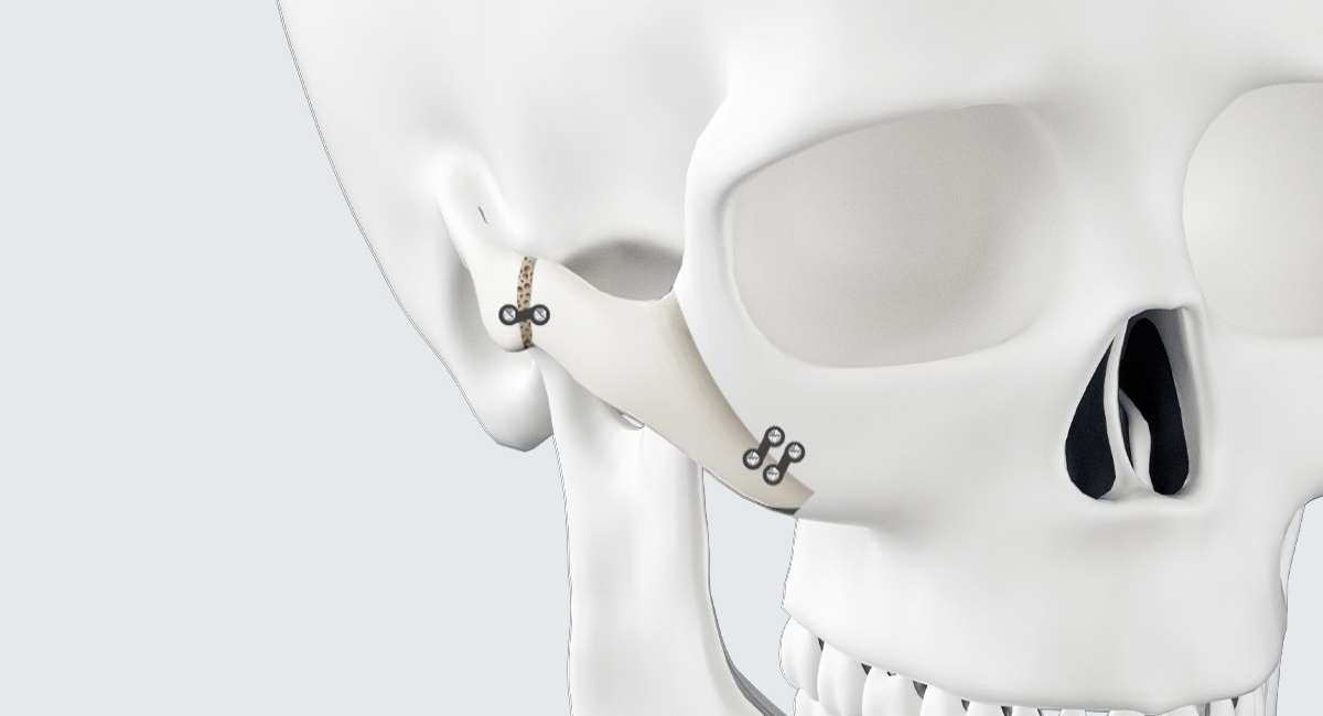 通过CT 确认 4D颧骨缩小真实案例 