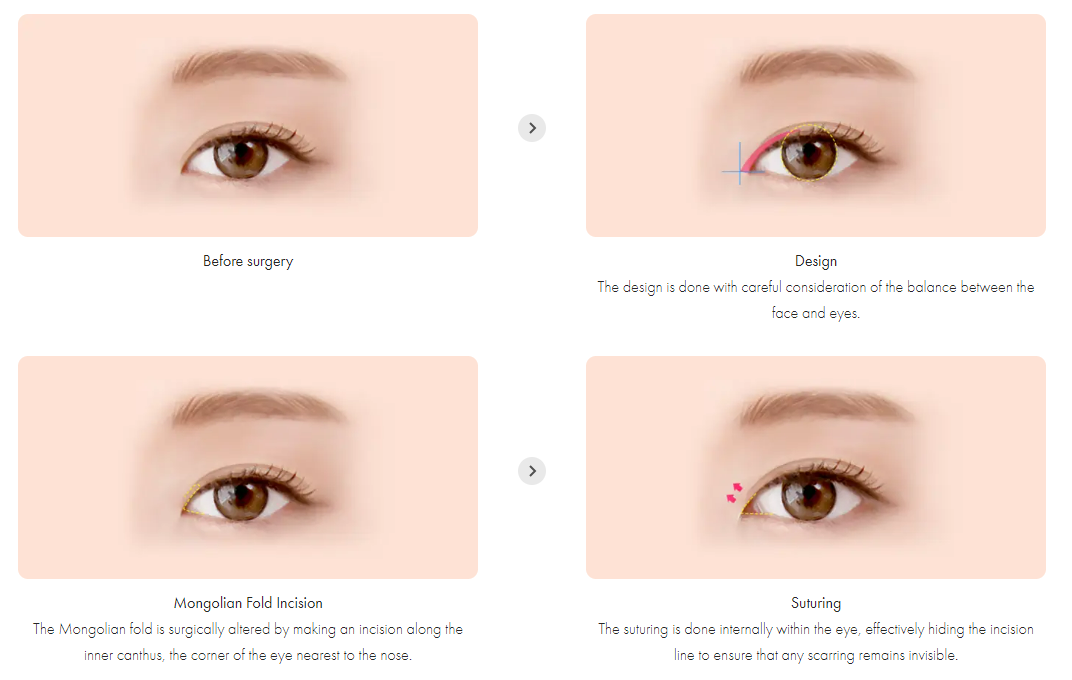 开内眼角手术是如何进行的