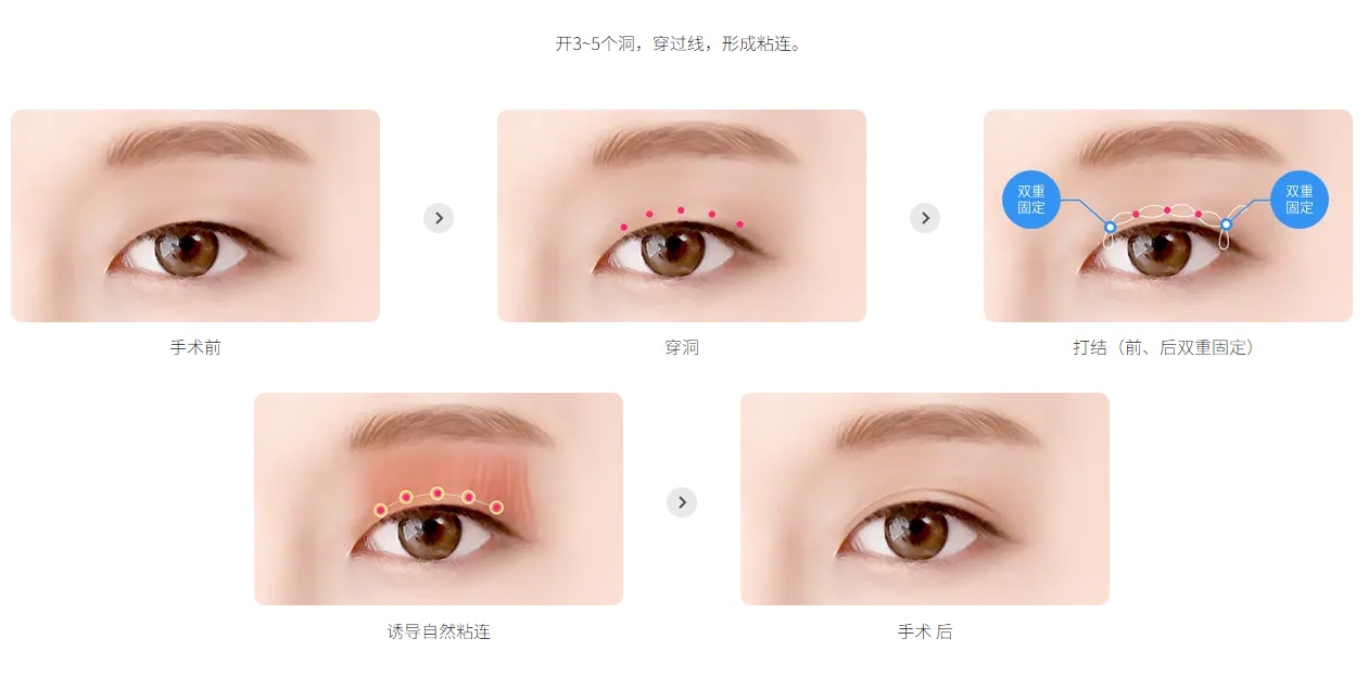 非切开双眼皮手术