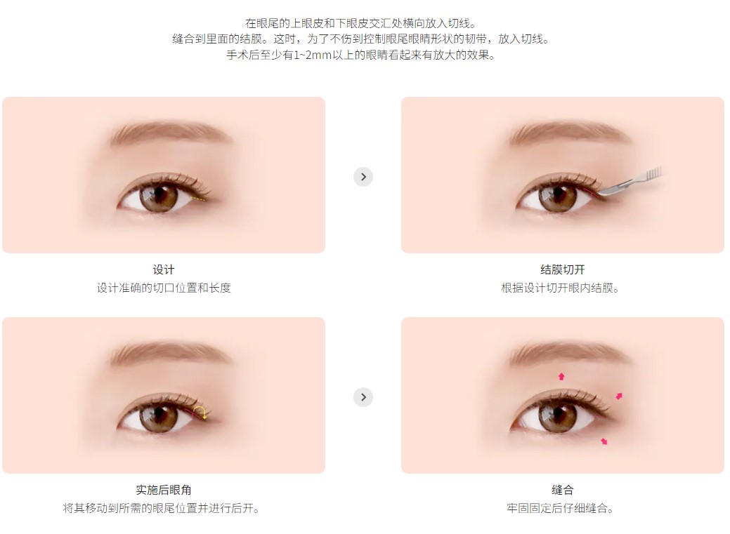 开外眼角手术