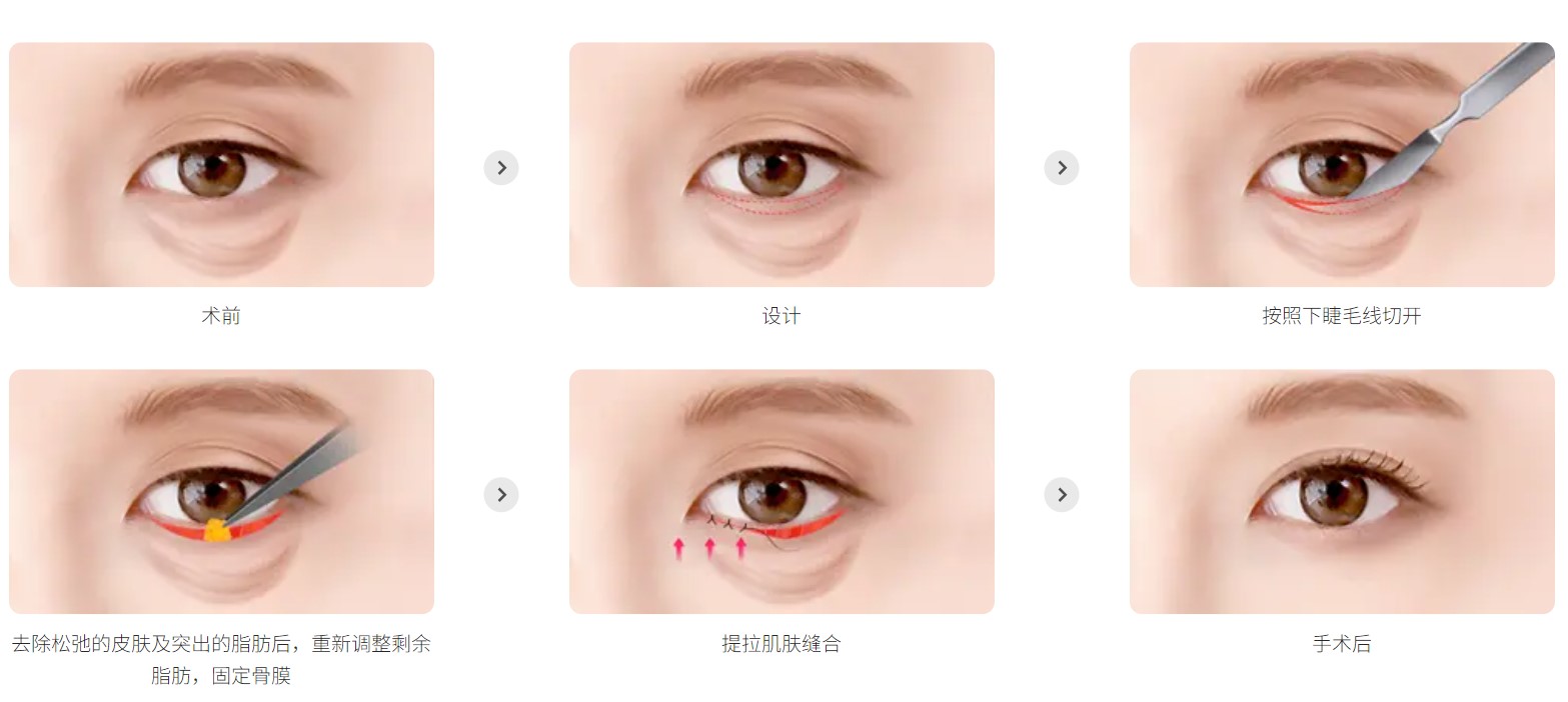 下眼睑手术（下眼睑成形术）