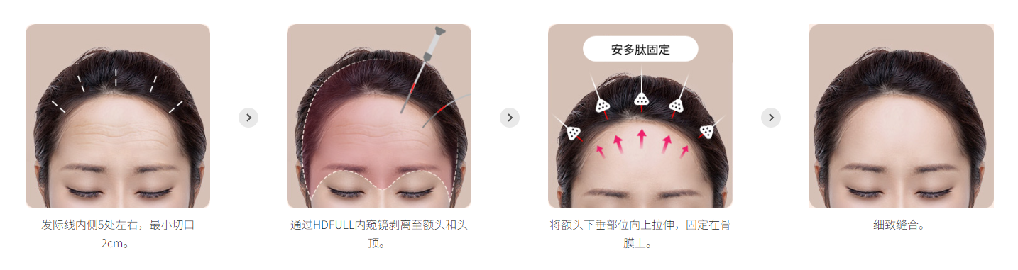 五爪钉植入物额头提升