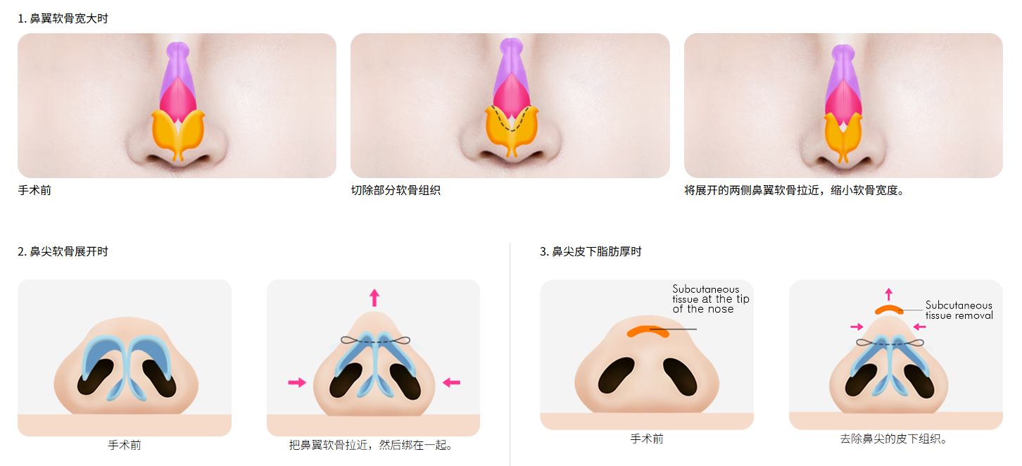 韩国的蒜头鼻整形手术