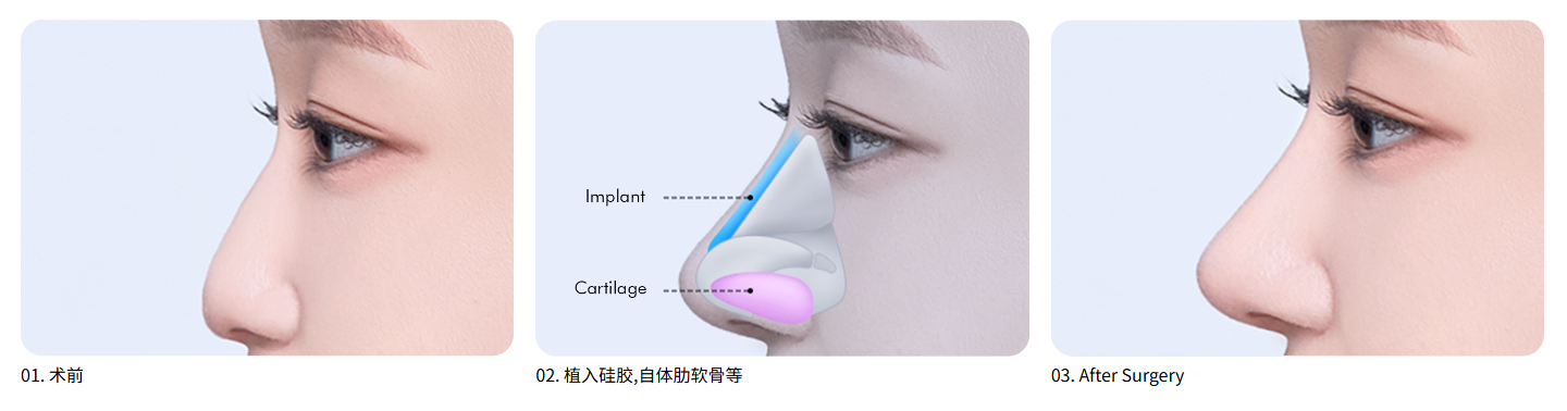 韩国的塌鼻整形手术
