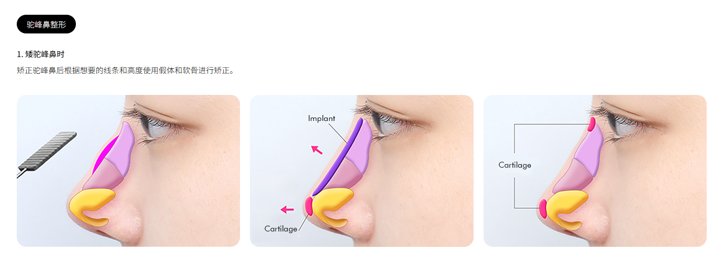 韩国的驼峰鼻整形手术