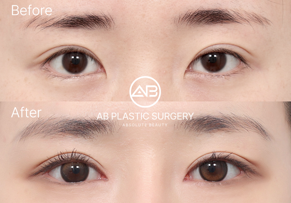 韩国眼整形前后对比照片