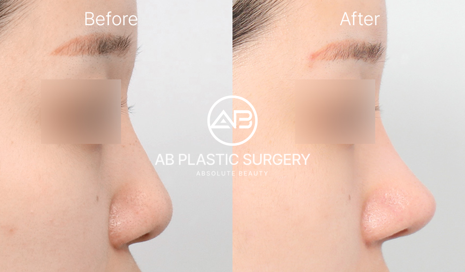 韩国鼻整形前后对比照片