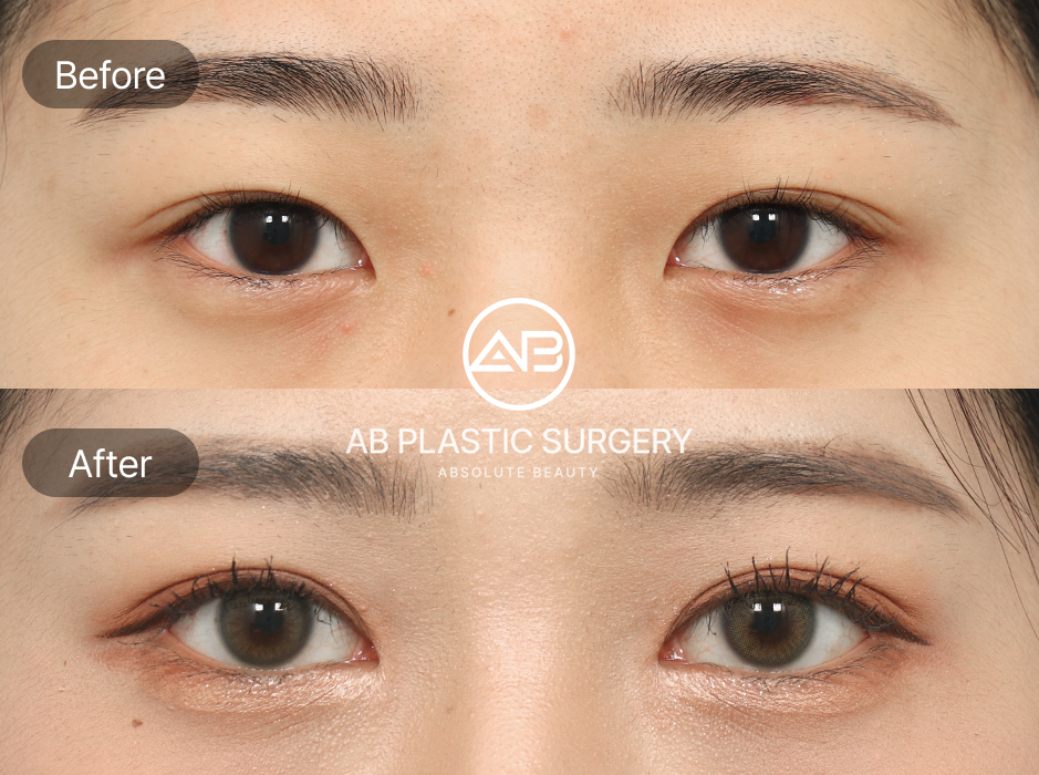 桃花眼整形前后对比照片