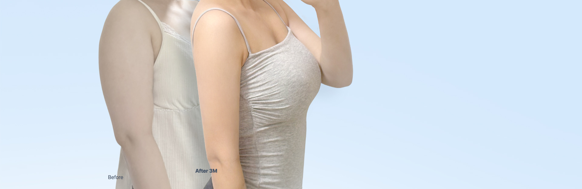 Arm liposuction before and after comparison