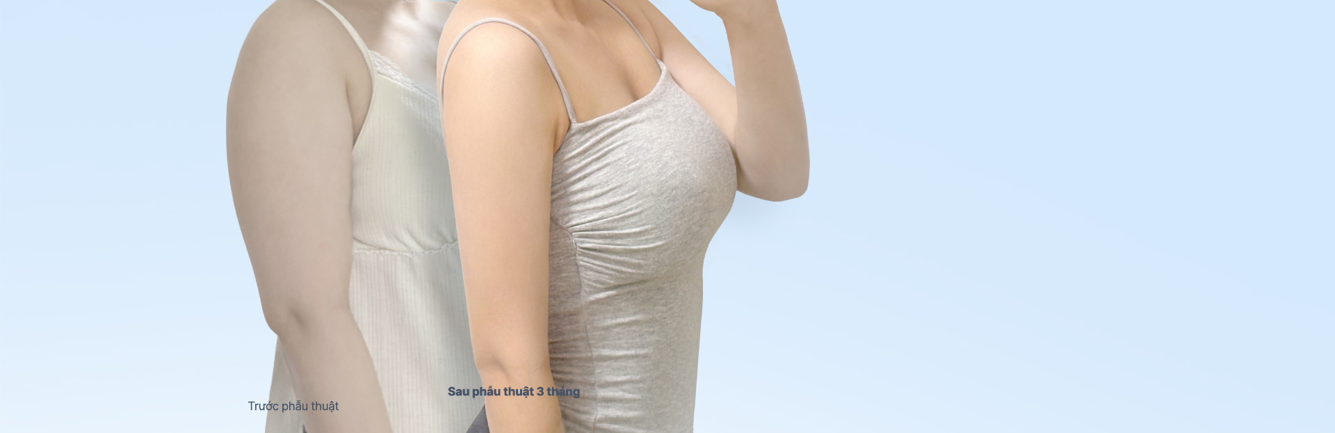 Arm liposuction before and after comparison