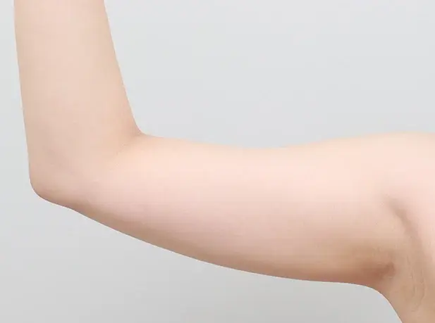 Before arm liposuction
