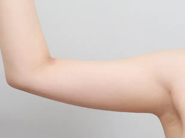 หลังผ่าตัด 1 เดือน arm liposuction