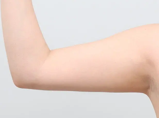 Before arm liposuction
