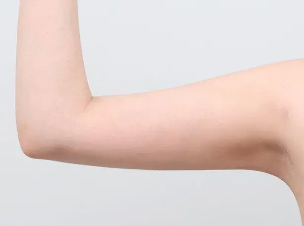 หลังผ่าตัด 1 เดือน arm liposuction