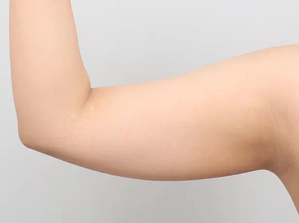 Before arm liposuction