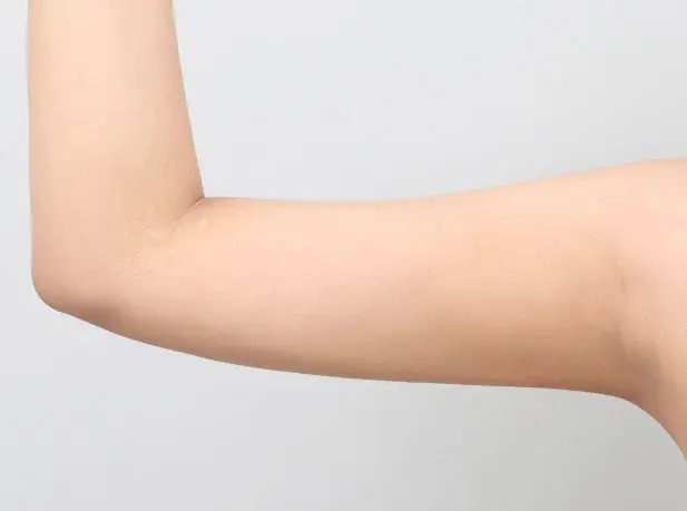 หลังผ่าตัด 1 เดือน arm liposuction