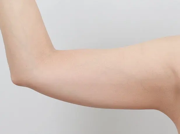 Before arm liposuction