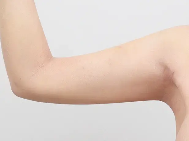 หลังผ่าตัด 1 สัปดาห์ arm liposuction