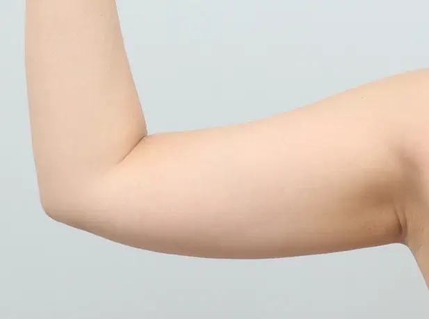Before arm liposuction