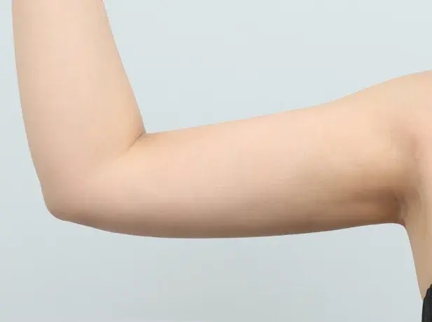 หลังผ่าตัด 2 เดือน arm liposuction