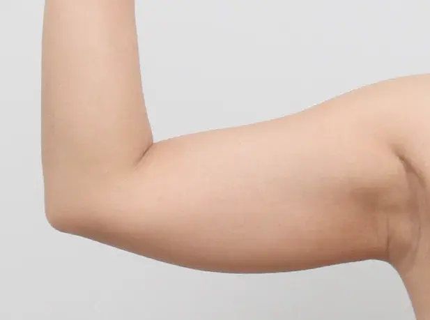 Before arm liposuction