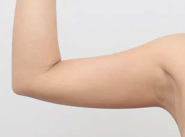 หลังผ่าตัด 2 เดือน arm liposuction