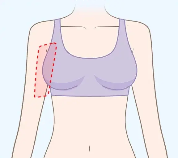 Excess fat on the inner arm