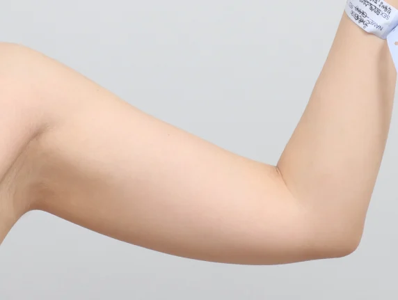 Arm liposuction ก่อนผ่าตัด
