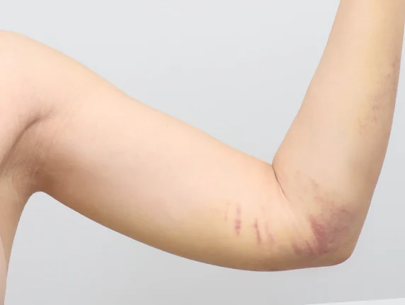 Arm liposuction หลังผ่าตัด 1 สัปดาห์