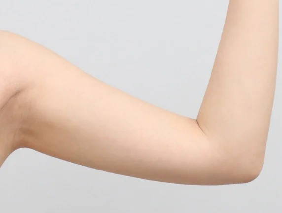 Arm liposuction หลังผ่าตัด 3 สัปดาห์