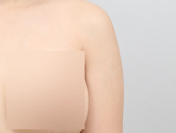 Arm liposuction ก่อนผ่าตัด