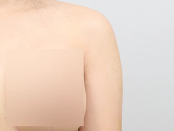 Arm liposuction หลังผ่าตัด 1 สัปดาห์