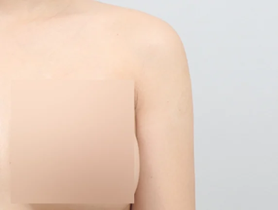 Arm liposuction หลังผ่าตัด 3 สัปดาห์