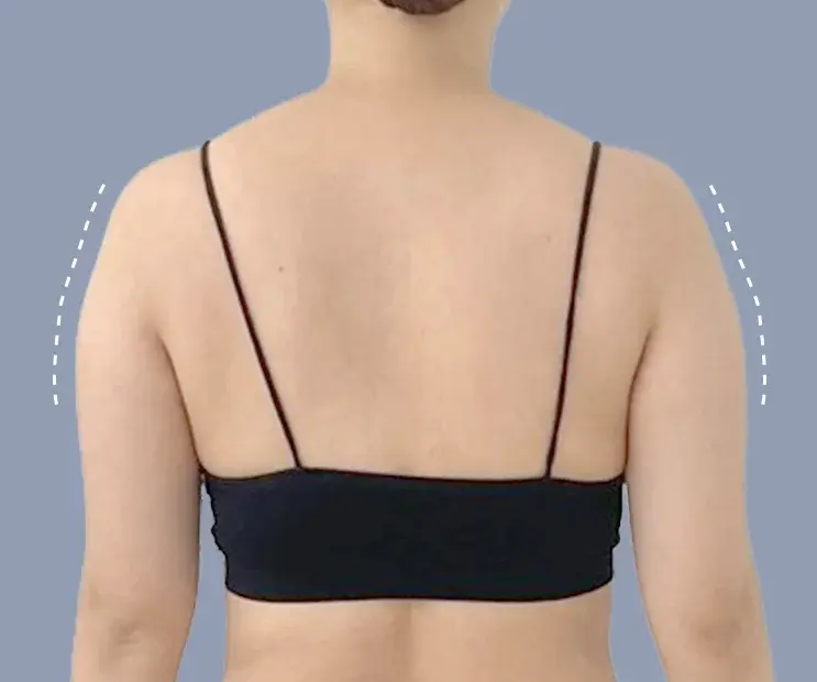 Concerned about arm lines after surgery
