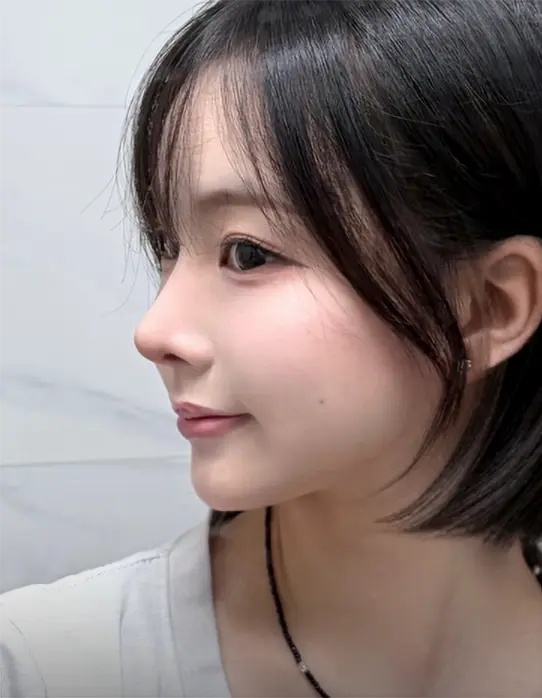 AB x SOFIT customized rhinoplasty 1