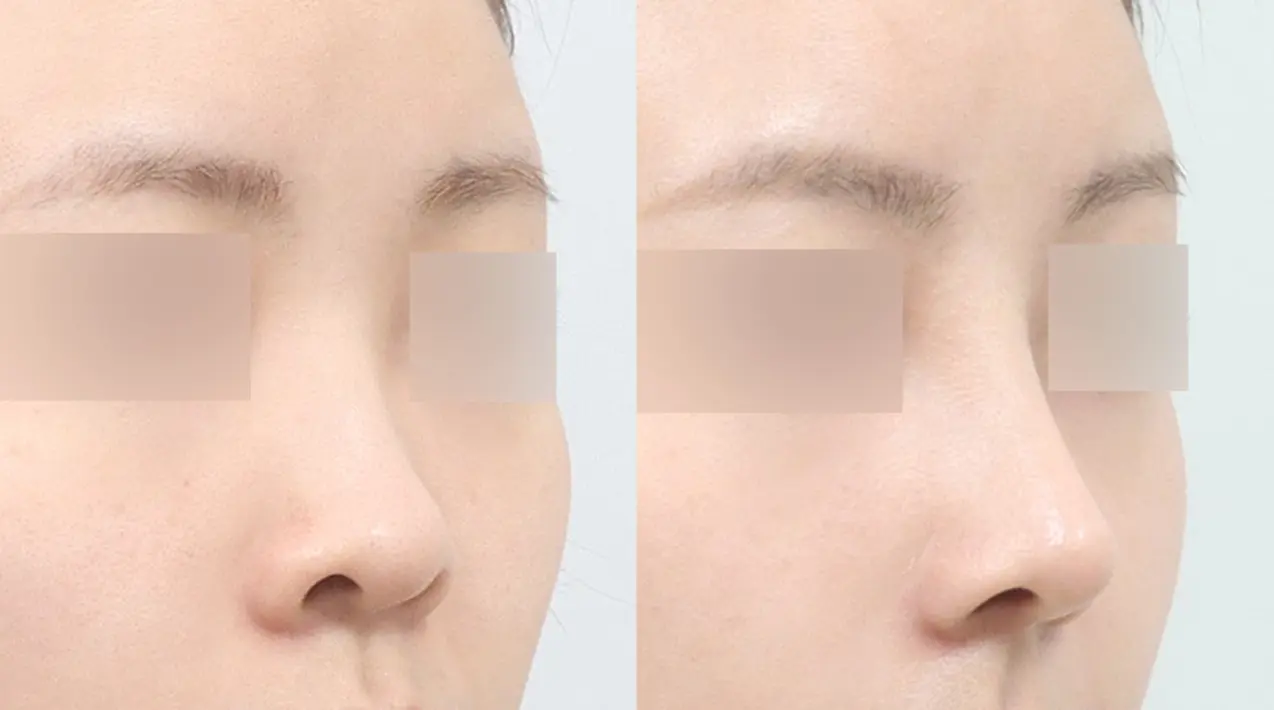 Đường sống mũi liền mạch mượt mà , ôm sát không tạo khoảng hở.