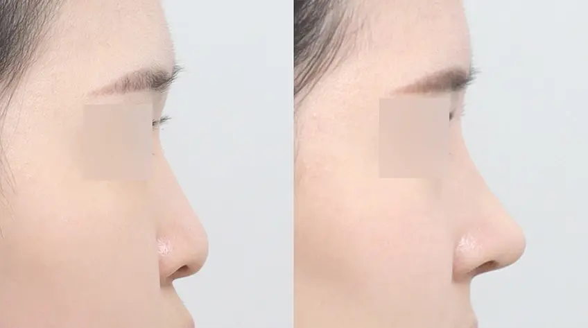 Thiết kế phù hợp với cấu trúc mũi Đầu mũi không bị chùng