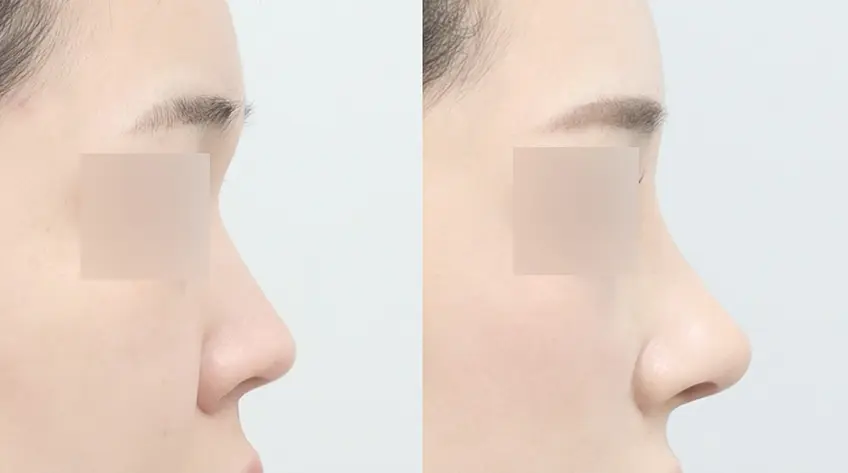 Thiết kế phù hợp với cấu trúc mũi Đầu mũi không bị chùng