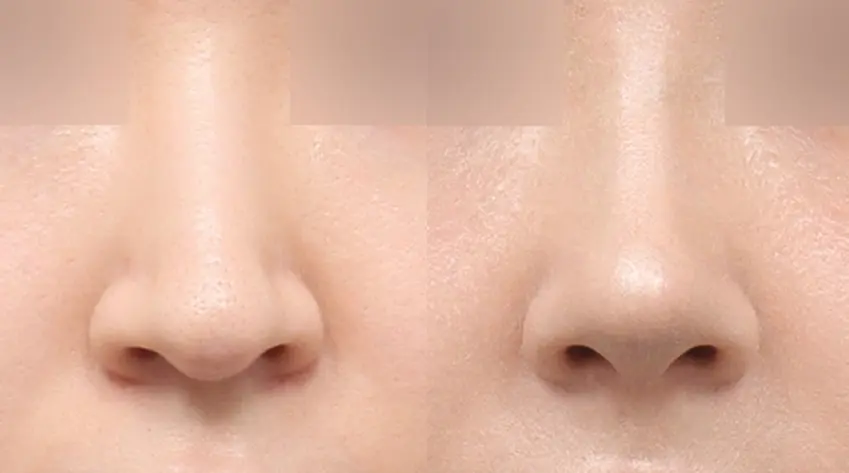 Đường trụ mũi cân đối , yếu tố quyết định độ hoàn thiện khi nhìn chính diện