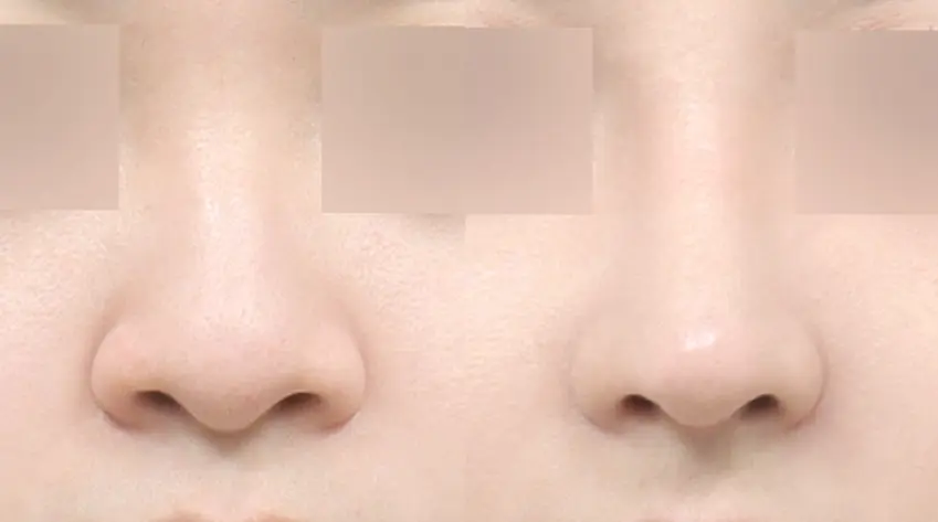 Đường trụ mũi cân đối , yếu tố quyết định độ hoàn thiện khi nhìn chính diện