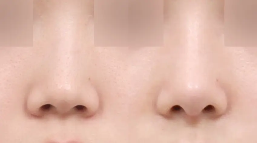 Đường trụ mũi cân đối , yếu tố quyết định độ hoàn thiện khi nhìn chính diện