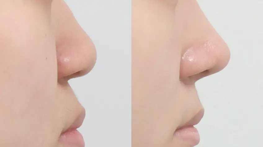 Góc mũi–môi được cá nhân hóa  hoàn thiện góc nghiêng hài hòa