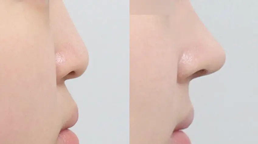 Góc mũi–môi được cá nhân hóa  hoàn thiện góc nghiêng hài hòa