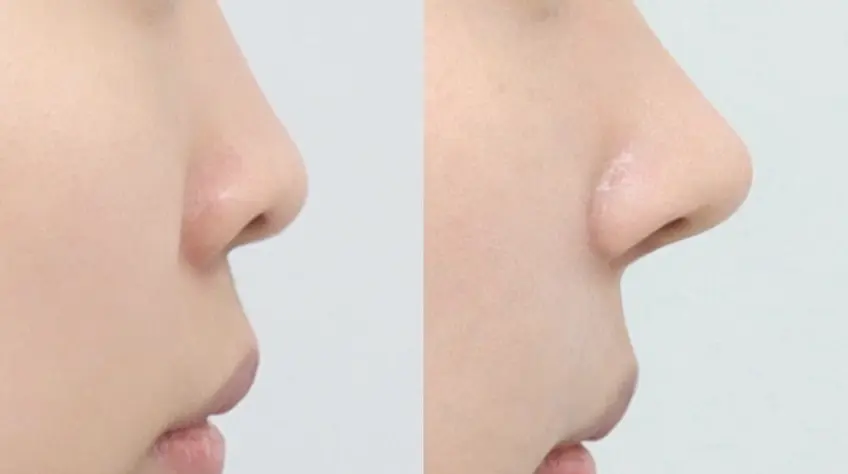 Góc mũi–môi được cá nhân hóa  hoàn thiện góc nghiêng hài hòa