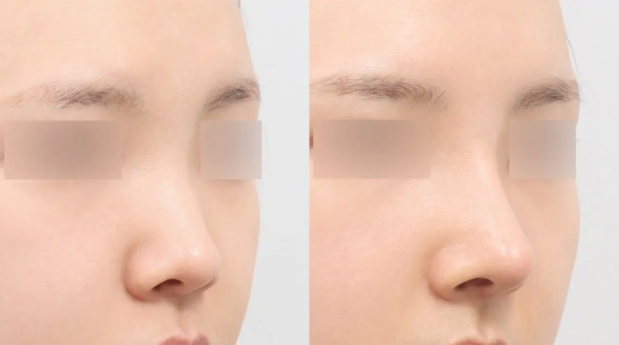Đường sống mũi liền mạch mượt mà , ôm sát không tạo khoảng hở.