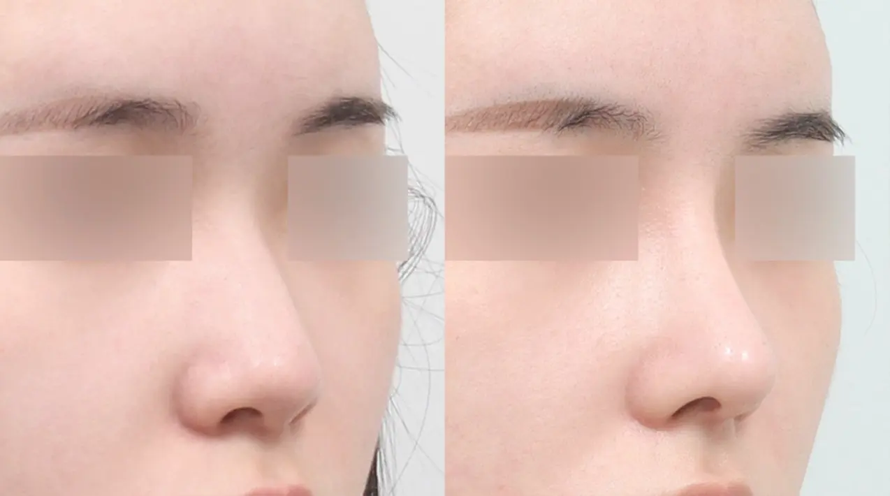 Đường sống mũi liền mạch mượt mà , ôm sát không tạo khoảng hở.