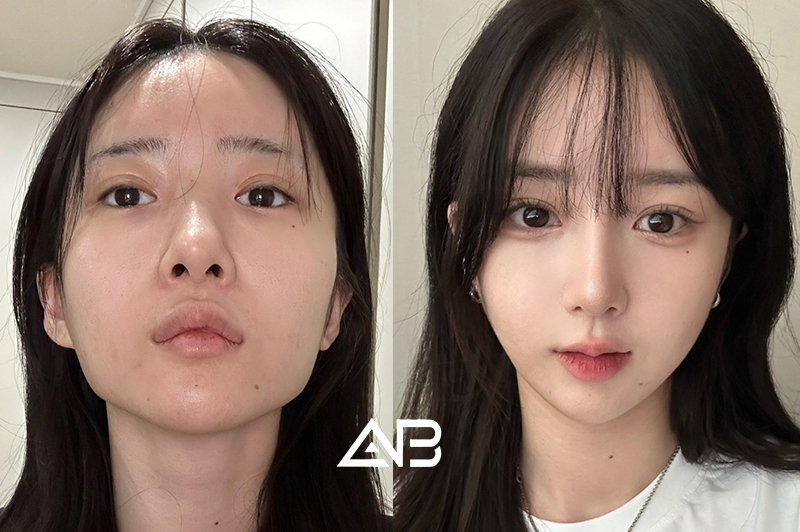 Facial Contouring Korea