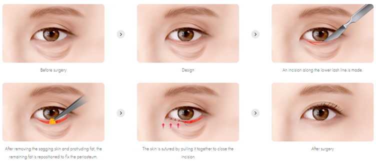 How Lower Blerpharoplasty Is Done