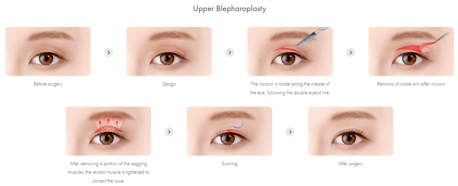 How Upper Blepharoplasty Is Done​​