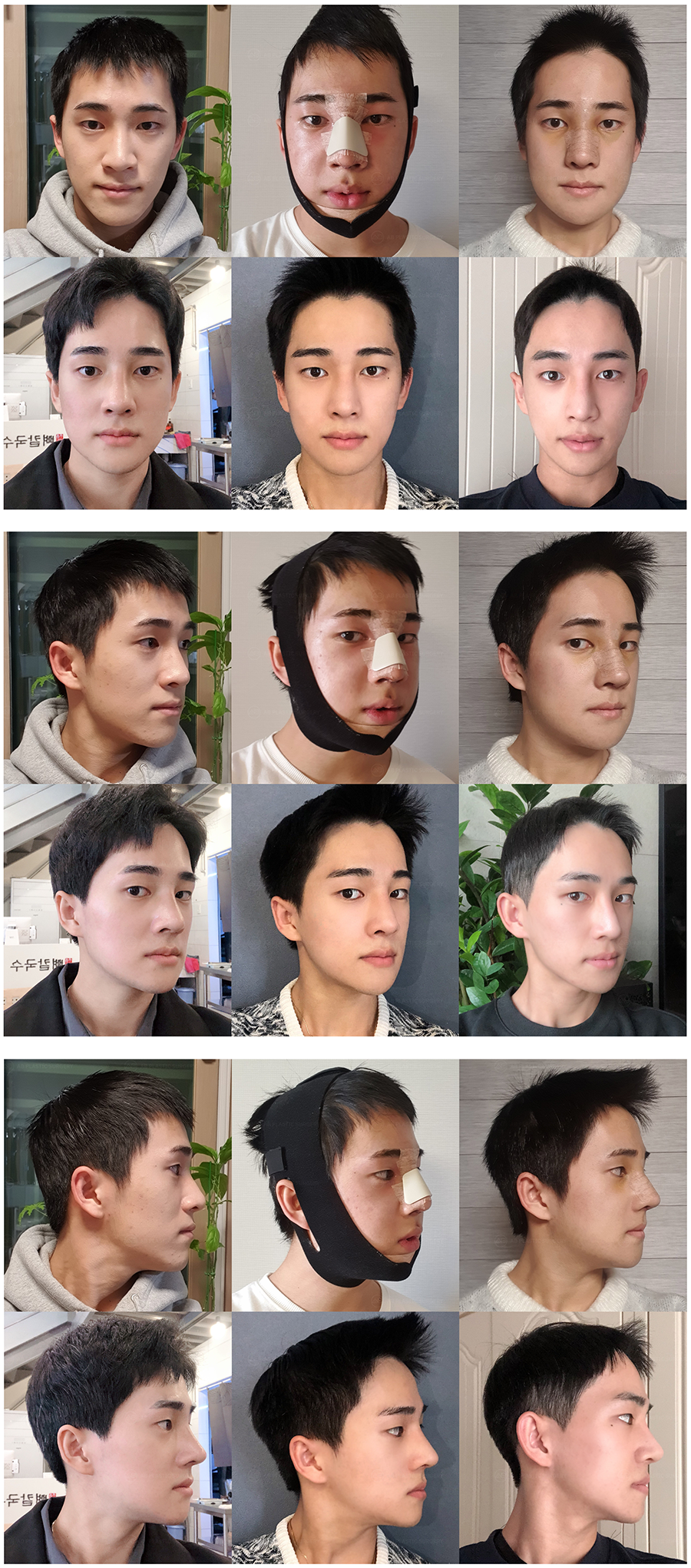 Before and After Male Rhinoplasty at AB Plastic Surgery Korea